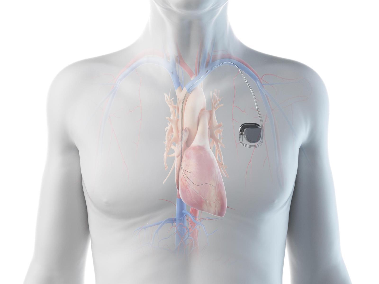 Rendering of man's chest with pacemaker